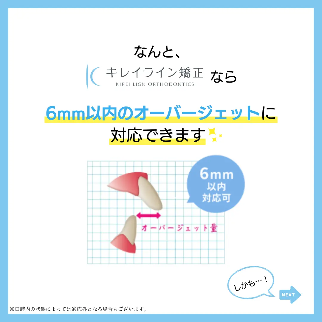 なんと、キレイライン矯正なら
6mm以内のオーバージェットに
対応できます：
6mm以内対応可
しかも・・・！
※口腔内の状態によっては適応外となる場合もございます。